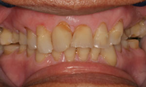 cracked tooth before crown