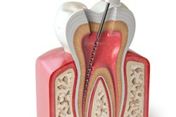 diagram showing the root canal treatment process 
