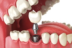 Model of a single dental implant with crown and abutment