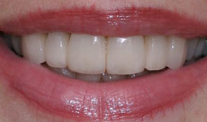 after dental bridges