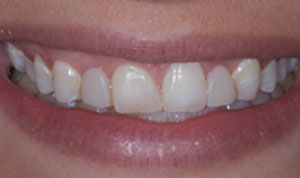 short teeth before bridges