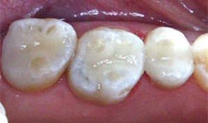 CEREC after