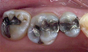 CEREC before