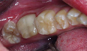 after CEREC