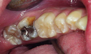 before CEREC