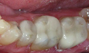 after Syracuse CEREC