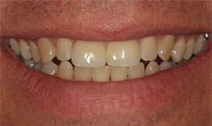 after cosmetic dentistry