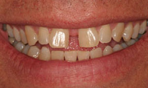 before cosmetic dentistry