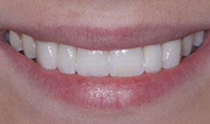 cosmetic dentistry after