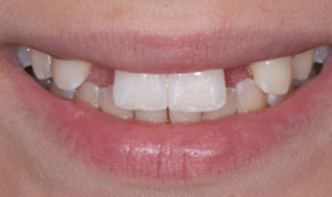 cosmetic dentistry before