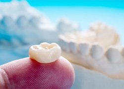 closeup of dental crowns in Syracuse
