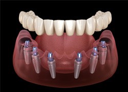 Illustration of implant dentures in Syracuse, NY
