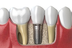 Diagram of how dental implants in Syracuse work