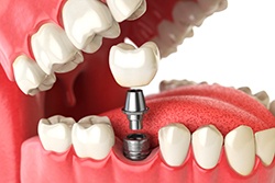 Diagram showing how dental implants in Syracuse are placed