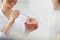 Syracuse implant dentist showing patient a model of dental implants