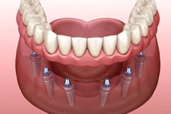 3D illustration of a lower implant denture