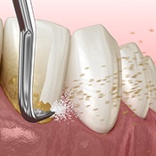 plaque being scraped off teeth