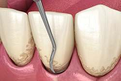 diagram of scaling under the gumline