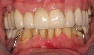 after smile makeover