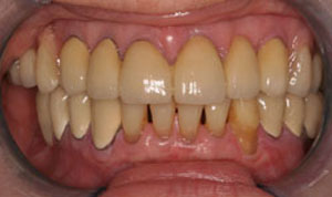 smile makeover after