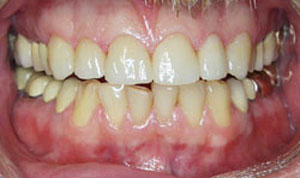 after porcelain veneers