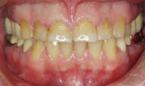 before porcelain veneers