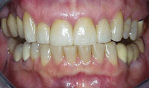 porcelain veneers after