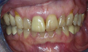 porcelain veneers before