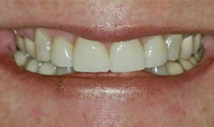 after creative dental concepts of CNY veneers