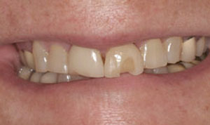 before creative dental concepts of CNY veneers