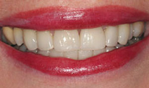 Bright smile after porcelain veneers