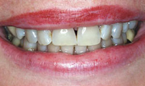 dull smile before porcelain veneers