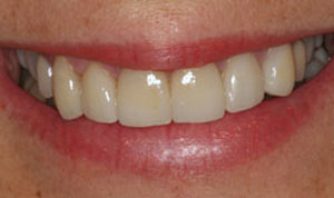 white teeth after veneers