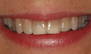 yellow teeth before veneers